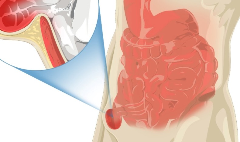 Brokk og stomi Brokk og stomi